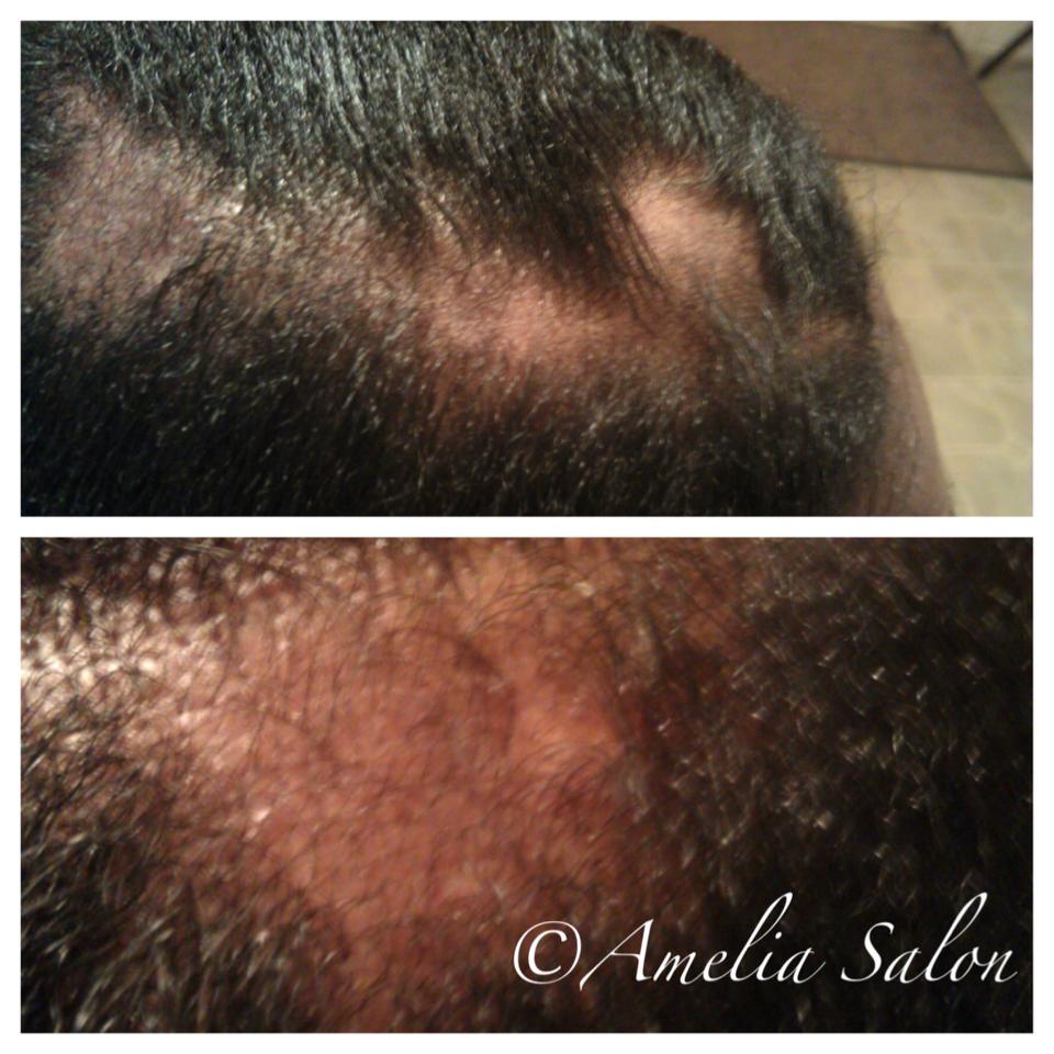 AmeliaSalon.com-Hair-loss-Lupus
