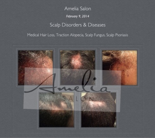 Scalp Disorders and Diseases